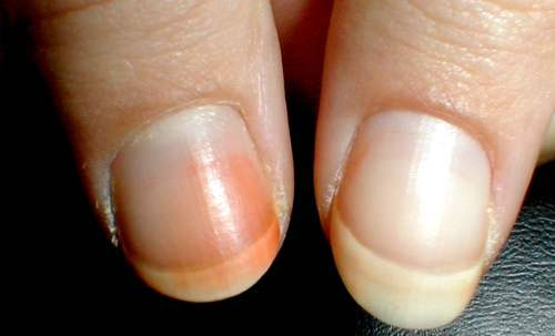 Beware of orange fingernails. - Journal - ThoughtShades